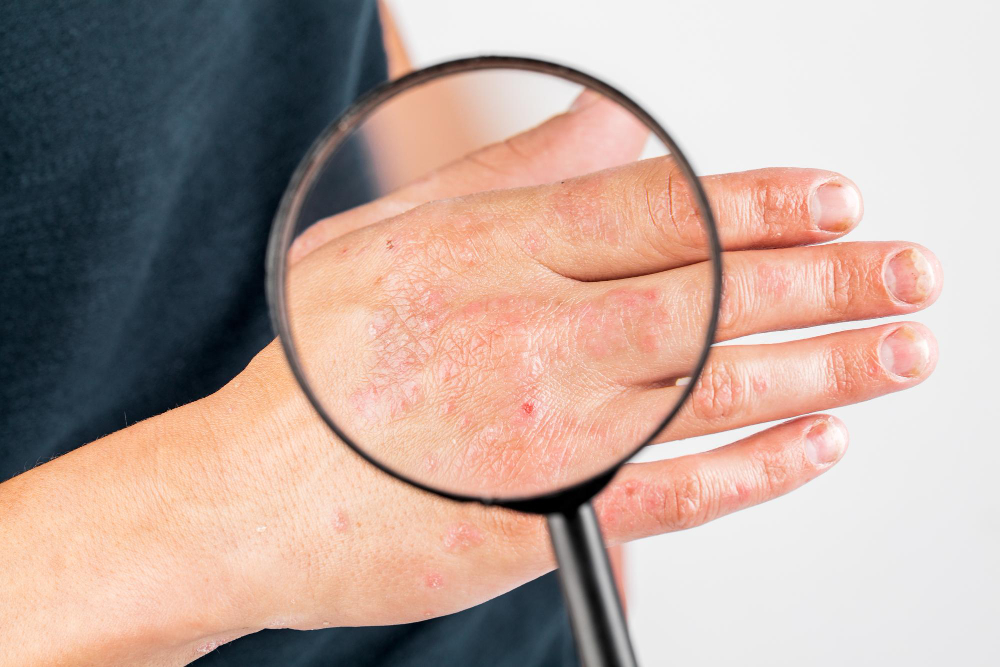 Eczema: Simptome, cauze și tratamente eficiente